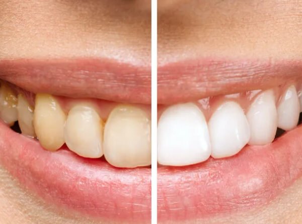 7 Questions To Ask Before Choosing Between Teeth Whitening And Bonding