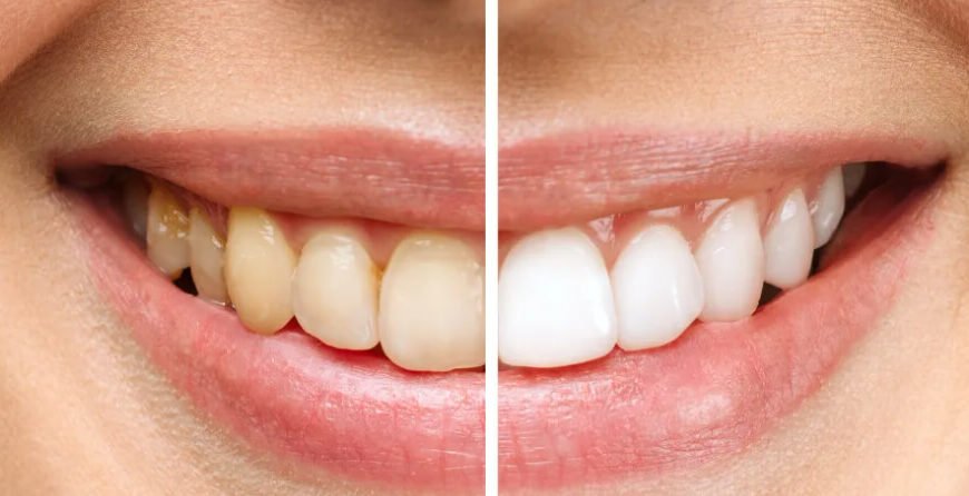 7 Questions To Ask Before Choosing Between Teeth Whitening And Bonding