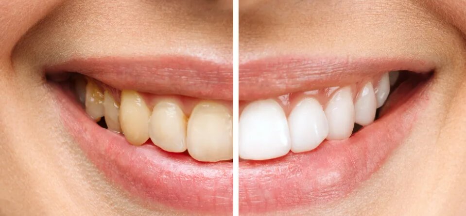 7 Questions To Ask Before Choosing Between Teeth Whitening And Bonding
